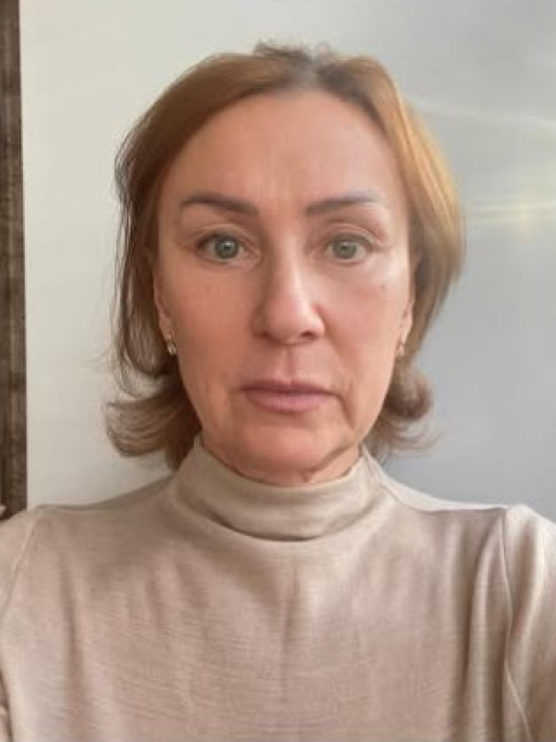 После: Эндоскопическая подтяжка лба и средней зоны лица